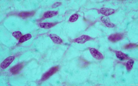 干细胞中风后抑郁症的临床案例