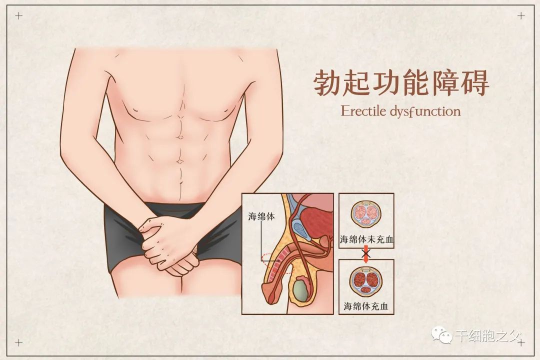 干细胞改善男性勃起功能障碍，恢复男性自信！