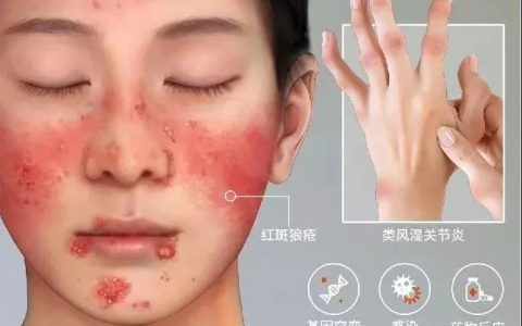 干细胞移植疗法：成为80多种自身免疫性疾病患者的新希望