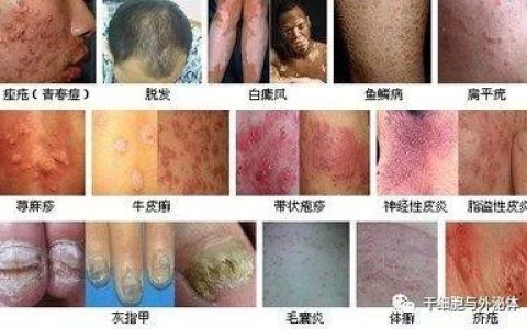 外泌体能有效防治多种皮肤疾病