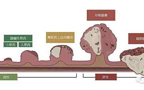 告别化疗之苦，细胞免疫疗法让直肠癌患者重获新生！