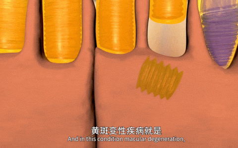 患者的自述：黄斑变性几乎失明，幸好遇见了干细胞！