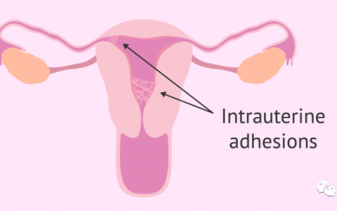 干细胞疗法在难治性妇科疾病中的临床应用