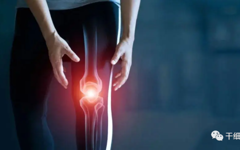 临床案例丨3项干细胞治疗骨关节炎的疗效观察