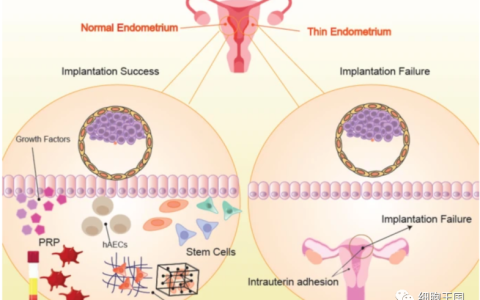 宫腔粘连综合症和薄型子宫内膜的细胞治疗