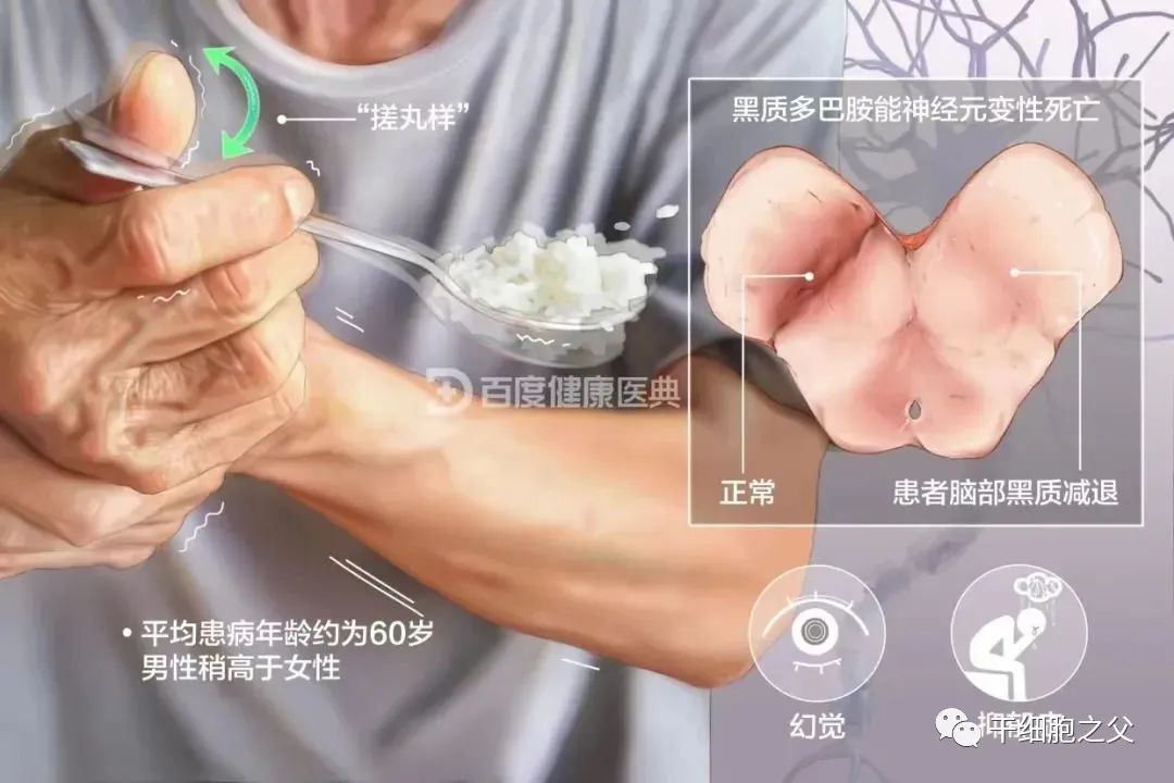 美国ISCO公布干细胞治疗帕金森成果，100%受试患者出现症状改善