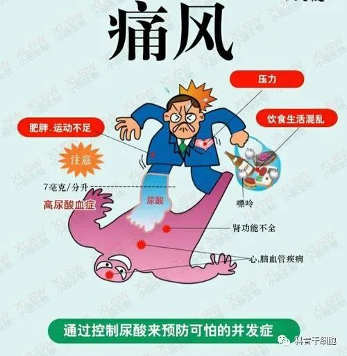 干细胞为痛风人群带来新希望
