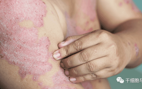 间充质干细胞在免疫系统疾病中的应用