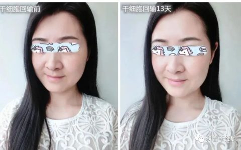 全记录 | 干细胞抗衰亲历者的100天