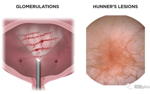 全球首次报道人类胚胎干细胞(ESC)衍生间充质干细胞(MSCs)在间质性膀胱炎上的临床应用