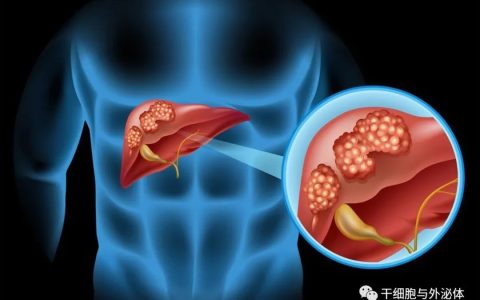 NK细胞在肝癌治疗中的应用