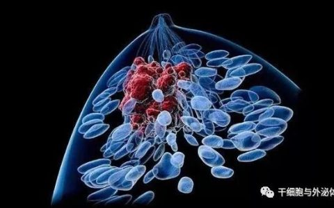 NK细胞在乳腺癌治疗中的应用