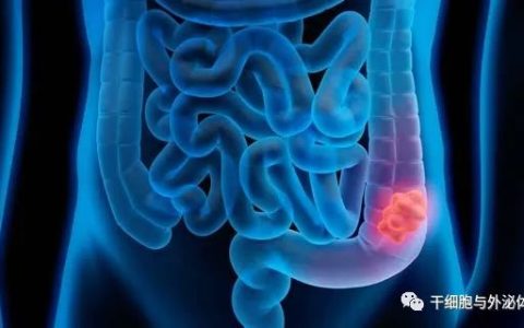 NK细胞在结肠癌治疗中的应用