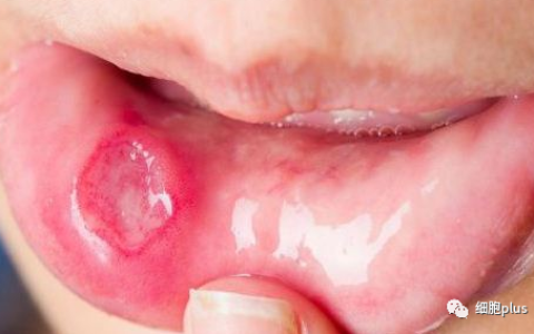 研究证明，磨人的口腔溃疡，间充质干细胞能帮忙