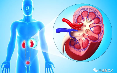 干细胞治疗26例慢性肾病的安全性和可行性评估