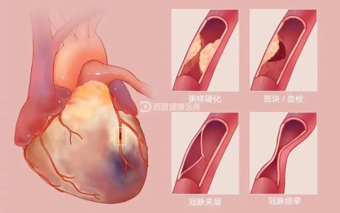 干细胞疗法-针对心肌梗死安全性与有效性的研究观察