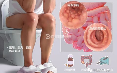 ​中南大学湘雅医院 | 间充质干细胞条件培养基成为炎症性肠病治疗新策略