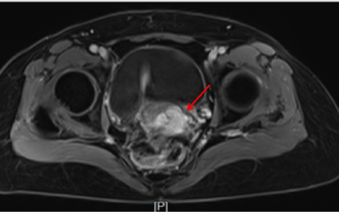 实体瘤的希望 | 国内首例TIL疗法治疗宫颈癌实现临床完全缓解