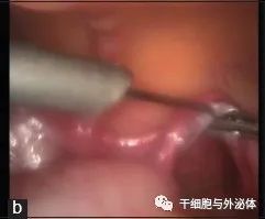 间充质干细胞疗法让绝经女性成功怀孕 | Stem Cell Rev and Rep