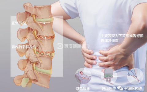 案例：干细胞治疗42例强直性脊柱炎的应用研究