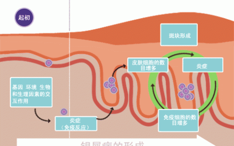 干细胞疗法在银屑病治疗中的临床应用及进展
