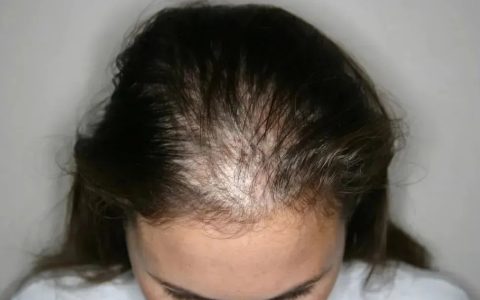 外泌体 | 解决“阳康”后脱发问题