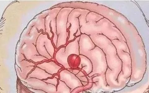 干细胞治疗脑出血后遗症，技术有效且安全！