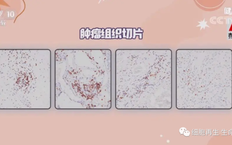 CCTV科教频道：免疫细胞疗法，可以帮助患者有效对抗肿瘤！