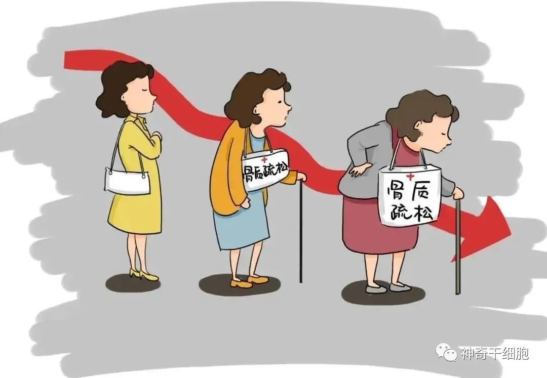 干细胞为健康加“骨”劲，有效改善骨质疏松症