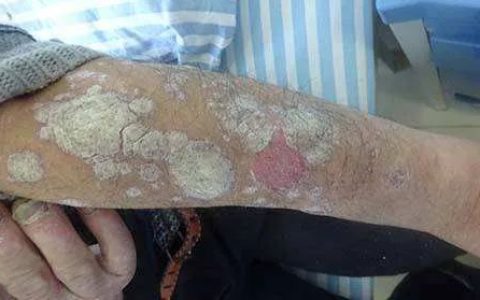 干细胞疗法对牛皮癣的临床项目已开展，我国700万患者的共同关注