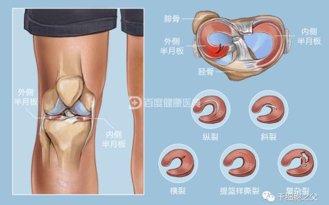 4个临床案例佐证：干细胞治愈半月板损伤更具有优势