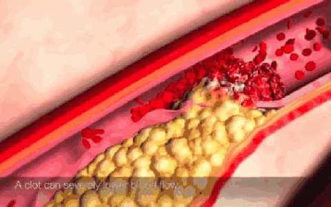 干细胞修复损伤血管，预防动脉粥样硬化