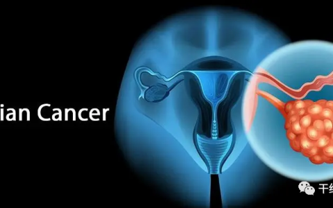 卵巢癌晚期多发转移，NK细胞疗法帮她实现长期生存