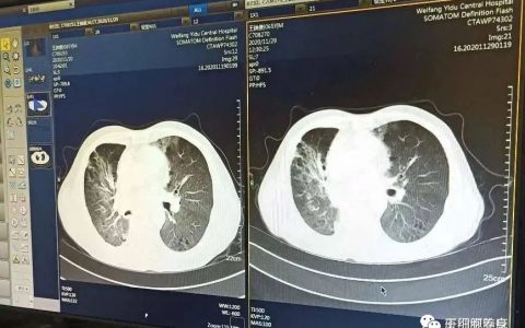 干细胞治疗肺纤维化的临床案例