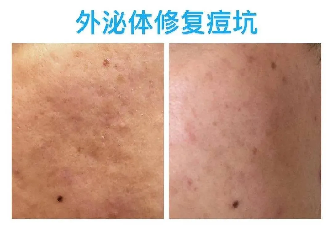 三分钟读懂外泌体，外泌体有哪些美容作用？（附部分应用效果）