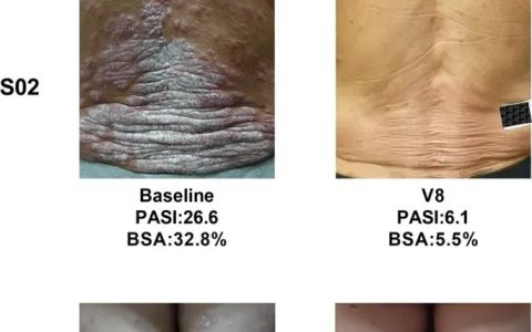 湘雅医院 | 间充质干细胞治疗牛皮癣对女性更有效，有效率为 66.7%