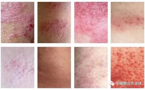 110例 | 间充质干细胞治疗带状疱疹后神经痛