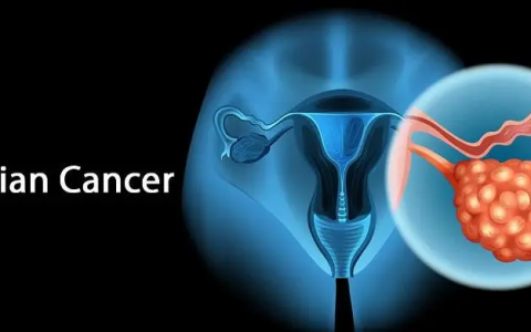 卵巢癌晚期多发转移，NK细胞调理帮她实现长期生存