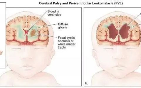 新闻报道丨央视CCTV：干细胞治疗脑瘫，他们迈出的一小步，人类医学一大步！