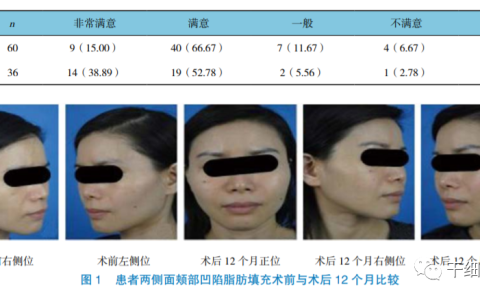 广医三院整形外科 | 自体脂肪及脂肪干细胞填充治疗面部老化96例疗效