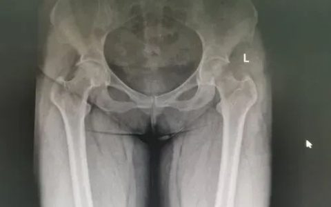 间充质干细胞移植治疗股骨头坏死11例报告