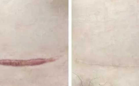 干细胞外泌体：能改善剖腹产所致的增生性瘢痕