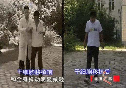 干细胞治疗小脑萎缩（真实案例）