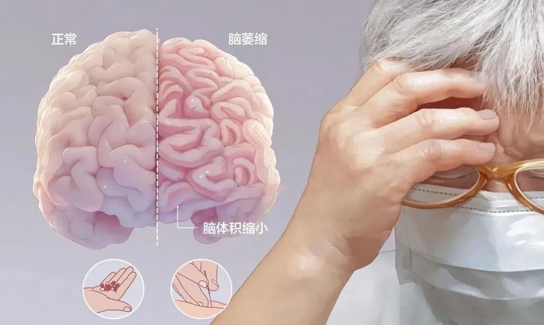 干细胞治疗小脑萎缩（真实案例）