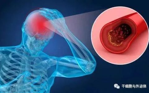 间充质干细胞治疗脑卒中哪种移植方式更有效？