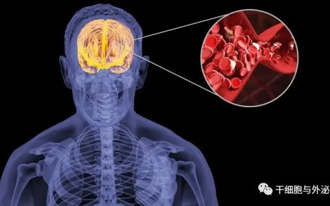 间充质干细胞移植联合康复治疗脑出血后遗症活动能力明显改善