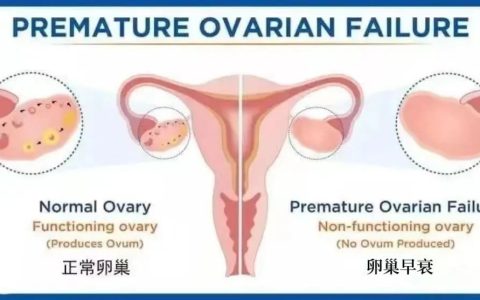 临床证实｜干细胞治愈卵巢早衰！痊愈10例，有效治疗13例，成功率高达92％