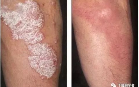 100%有效？间充质干细胞竟能从根本上完全治愈牛皮癣！