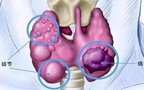 改善甲状腺健康，免疫细胞疗法来帮忙！