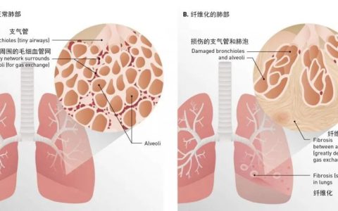 干细胞在肺纤维化的临床应用